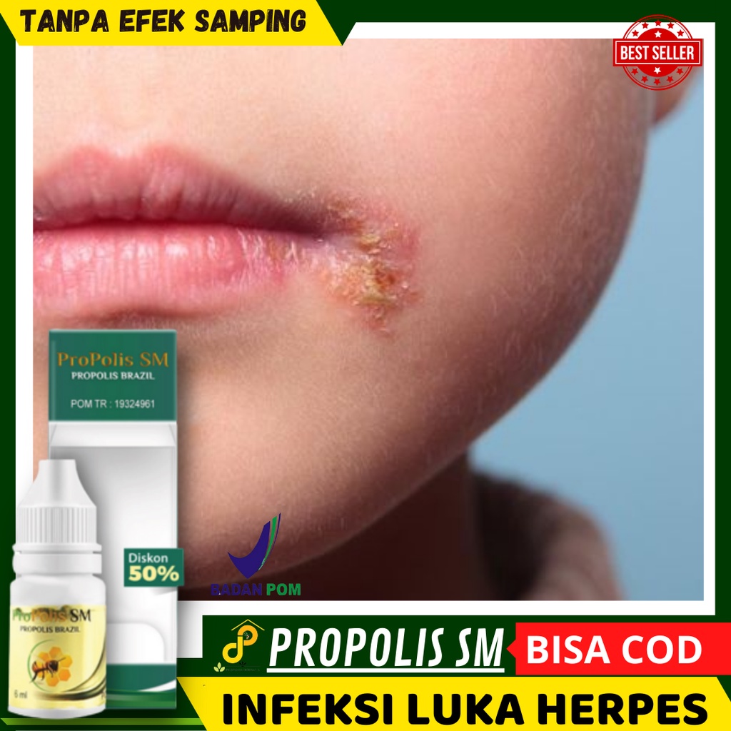 Jual Cara Menghilangkan Herpes Di Kelopak Mata Menghilangkan Herpes