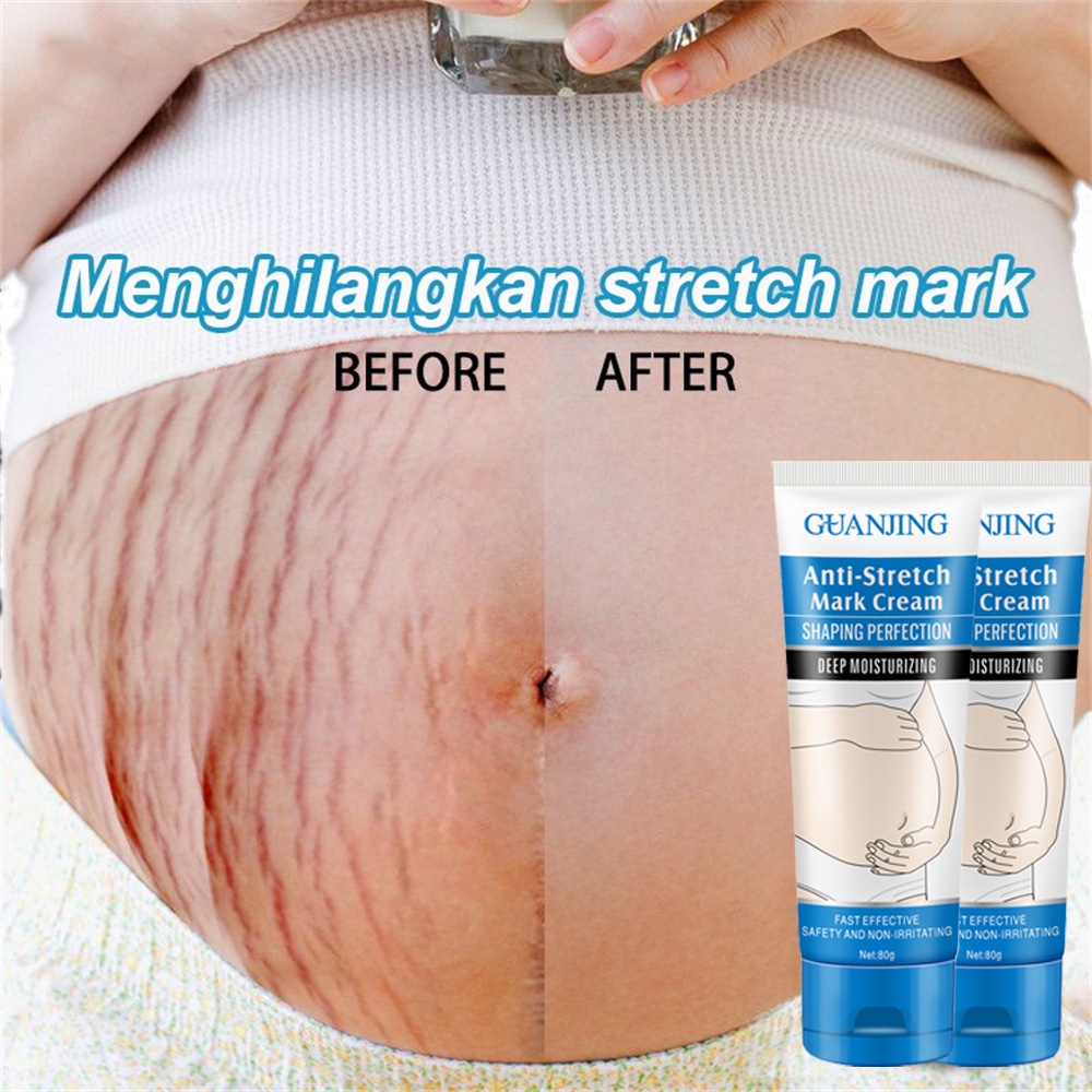 Jual Penghilang Stretch Mark Krim Cream Menghilangkan Bekas Luka Krim