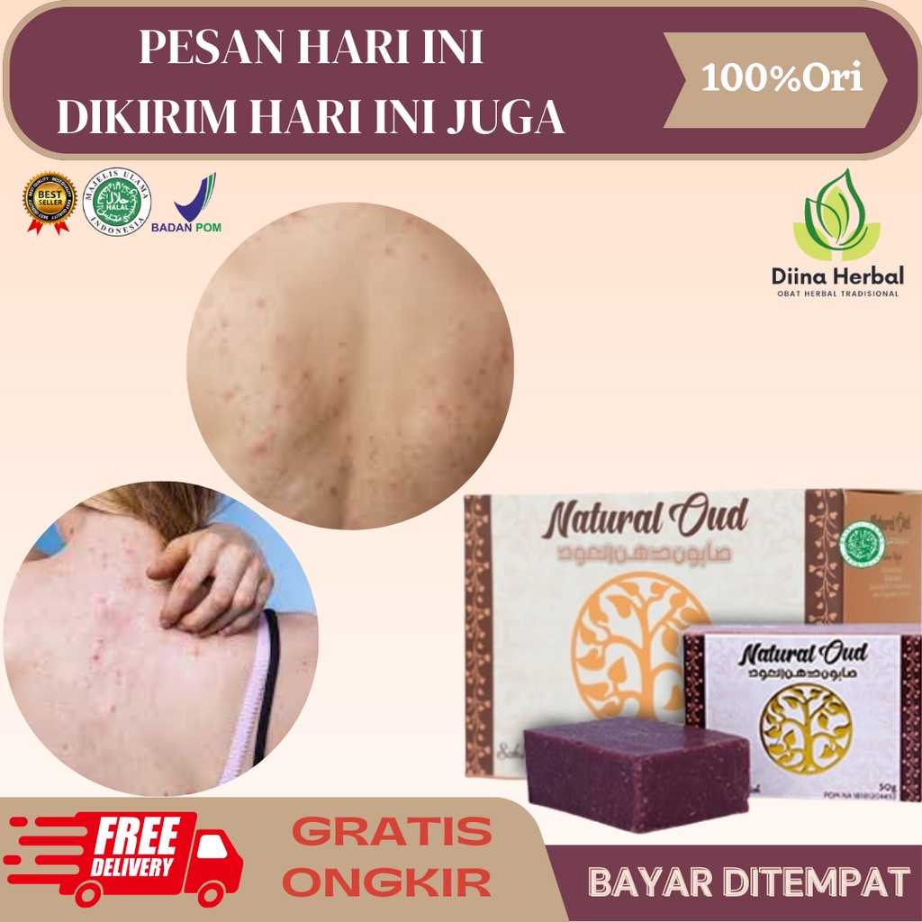 Jual Obat Gatal Gatal Di Punggung Gatal Biang Keringat Bintik Merah Di