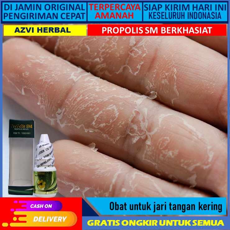 Jual Obat Jari Tangan Kering Obat Jari Tangan Kering Obat Jari Tangan