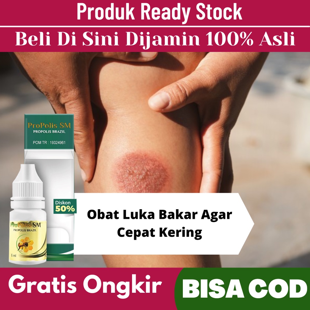 Jual Obat Luka Bakar Agar Cepat Kering Menghilangkan Bekas Luka Bakar