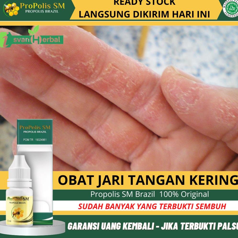 Jual Obat Jari Tangan Pecah Pecah Telapak Tangan Kasar Kuman Air