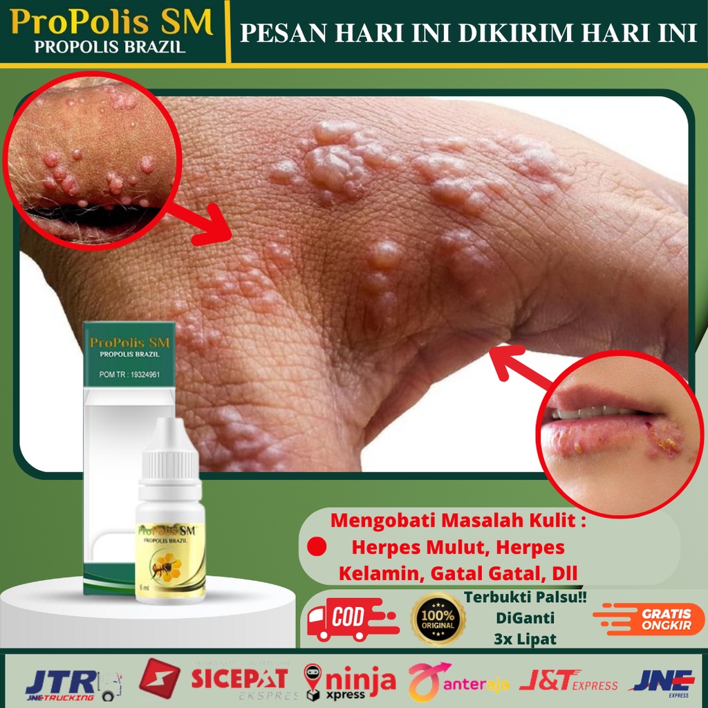 Jual Obat Oles Salep Herpes Kelamin Herpes Genital Obat Herpes