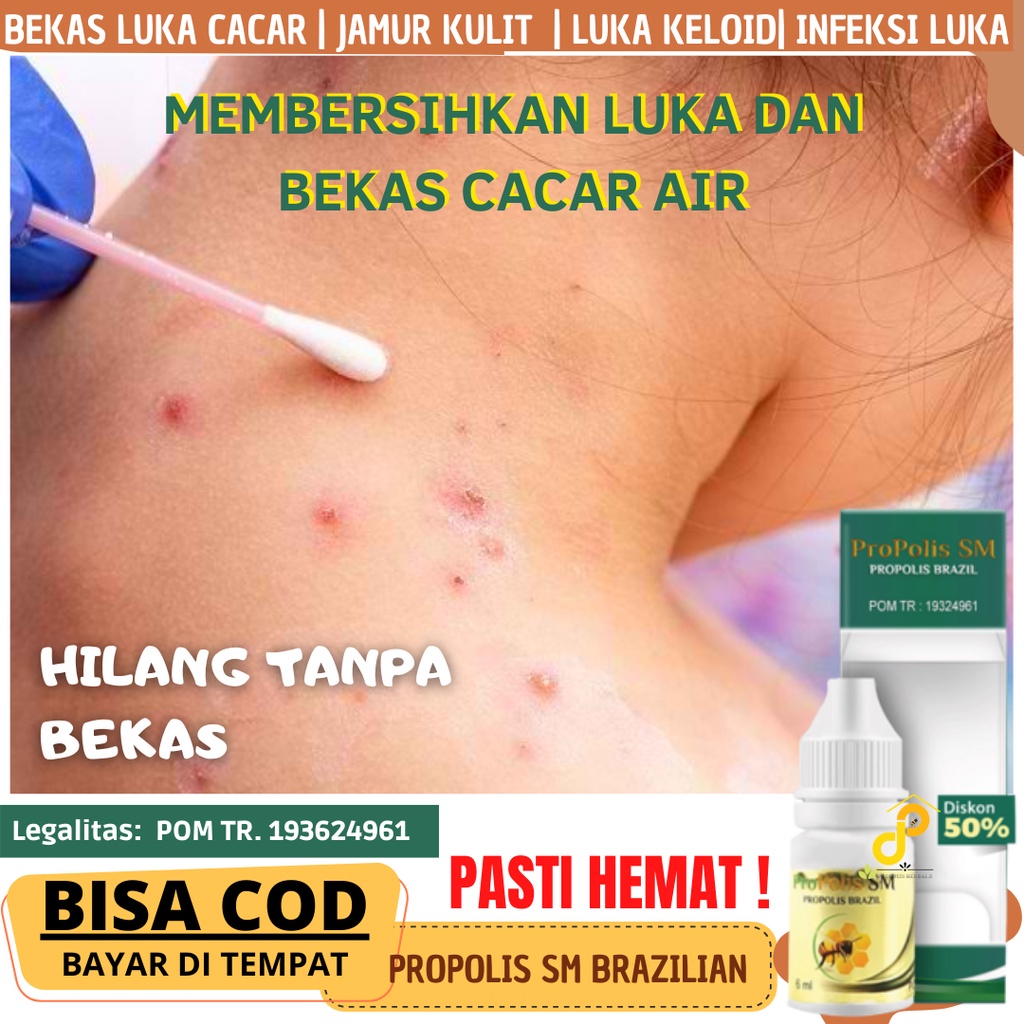 Jual Cara Mengobati Cacar Air Agar Cepat Kering Dan Hilang Propoolis