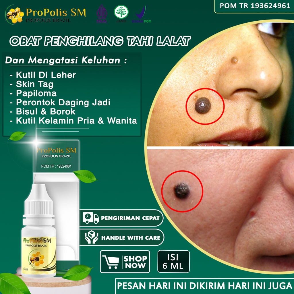 Jual Obat Penghilang Tahi Lalat Papiloma Perontok Kutil Penghilang Skin