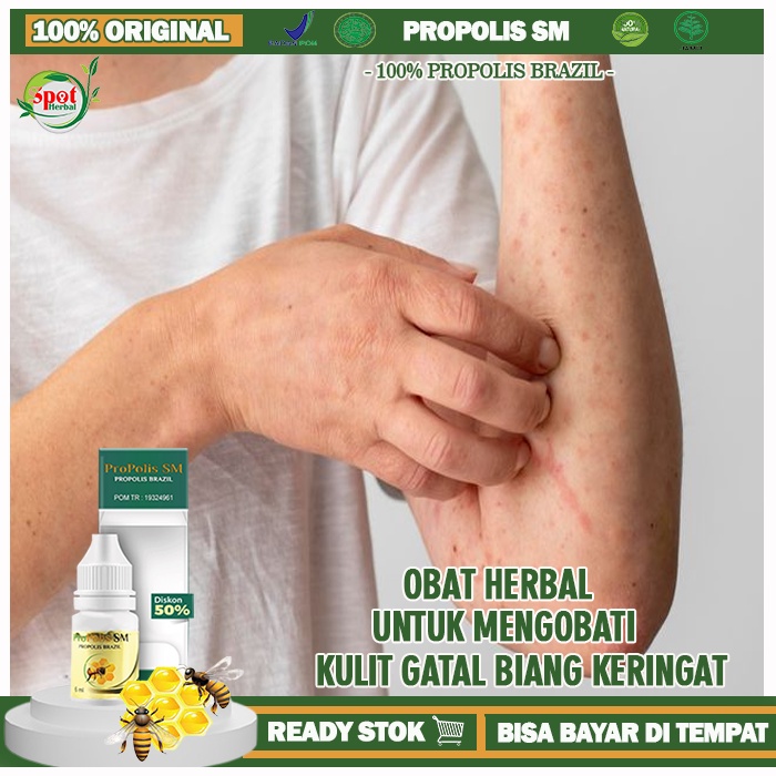 Jual Obat Biang Keringat Kulit Gatal Obat Biang Keringat Di Leher