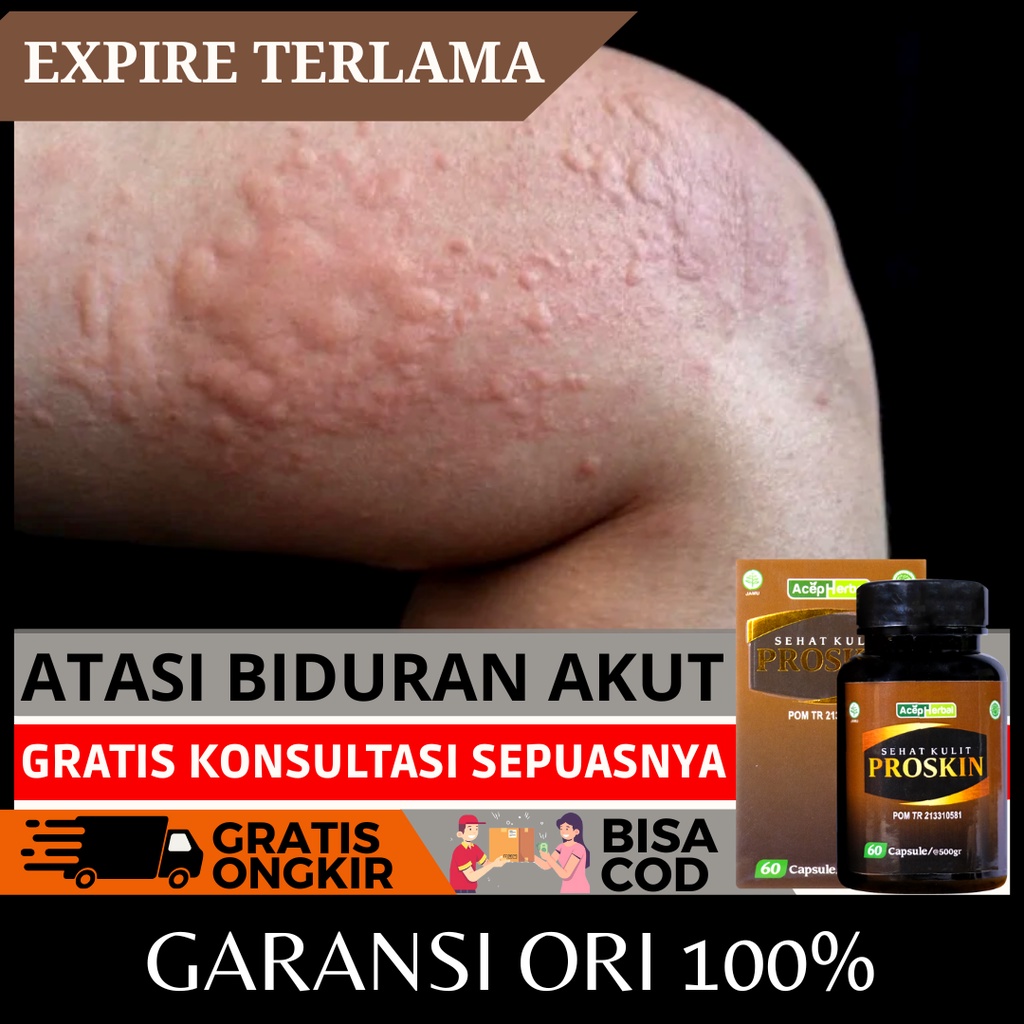 Jual Obat Biduran Menahun Alergi Kulit Gatal Ruam Bintik Merah Bentol