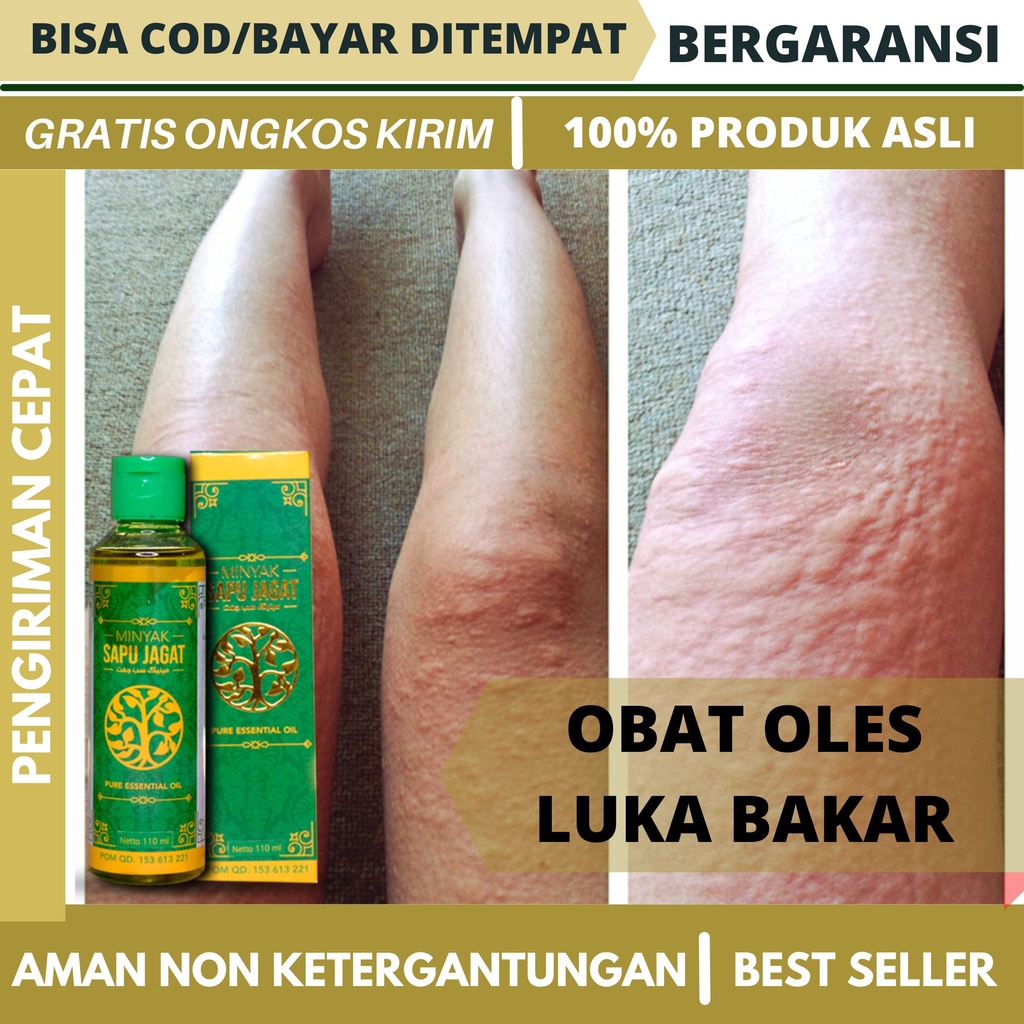 Jual Obat Gatal Kaligata Obat Biduran Obat Bentol Bentol Badan Gimpa