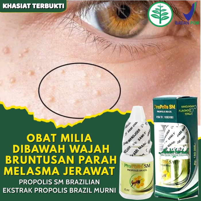 Jual Obat Milia Di Bawah Wajah Obat Penghilang Milia Obat Milia Pada