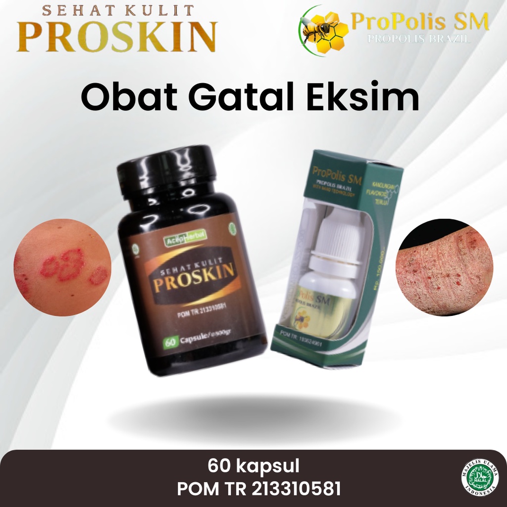 Jual Propolis Sm Obat Eksim Kering Eksim Di Kaki Gatal Exsim Eksim