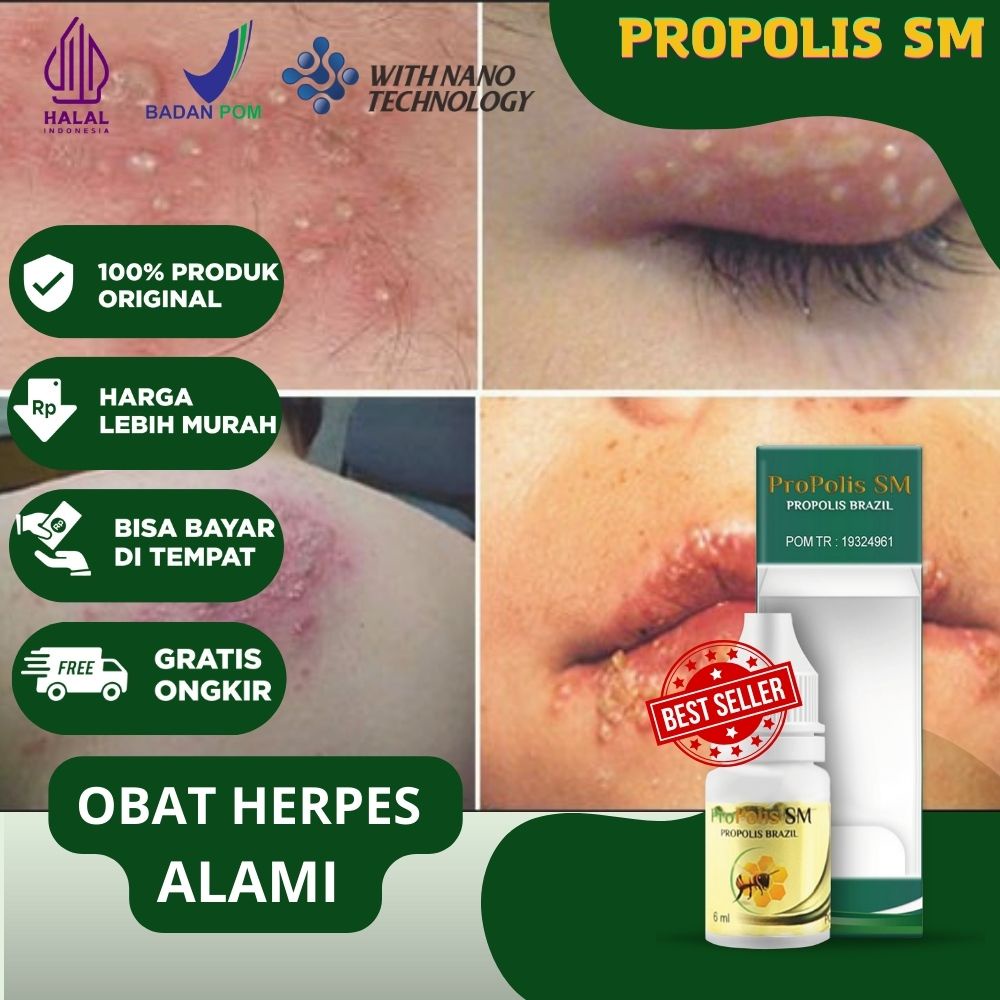 Jual Obat Herpes Virus Herpes Penyakit Kulit Herpes Genital Simpleks