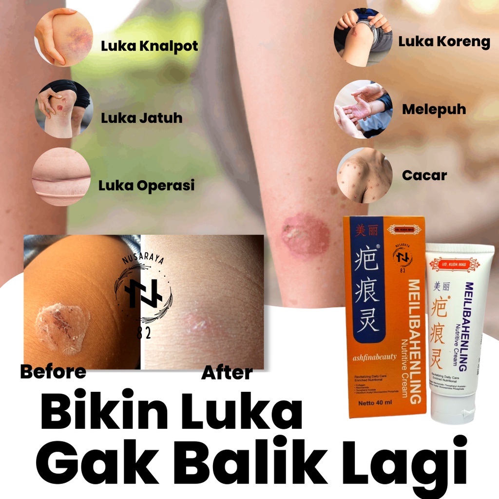 Jual Obat Kadas Kurap Paling Ampuh Salep Penghilang Bekas Luka Koreng