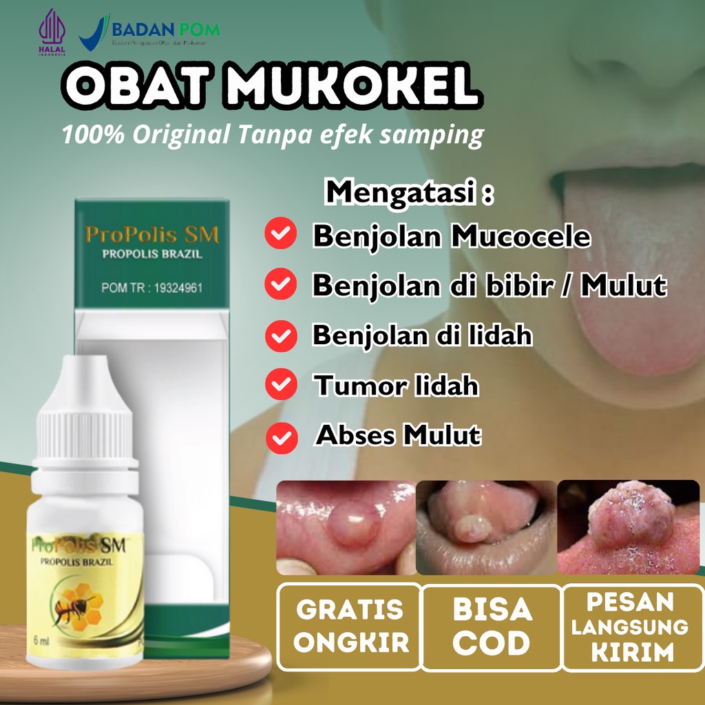 Jual Obat Penghilang Benjolan Mucocele Mukokel Penghilang Benjolan