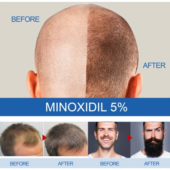 Jual Minoxidil Extra Strength Penumbuh Rambut Ml Penumbuh Rambut