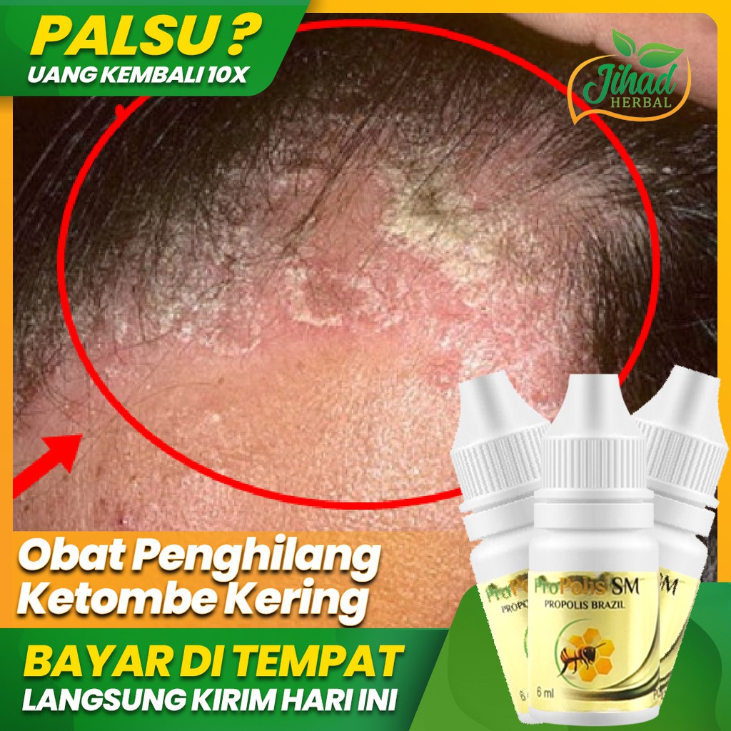 Bosan dengan Ketombe? 12 Rekomendasi Obat yang Efektif untuk Menghilangkannya!