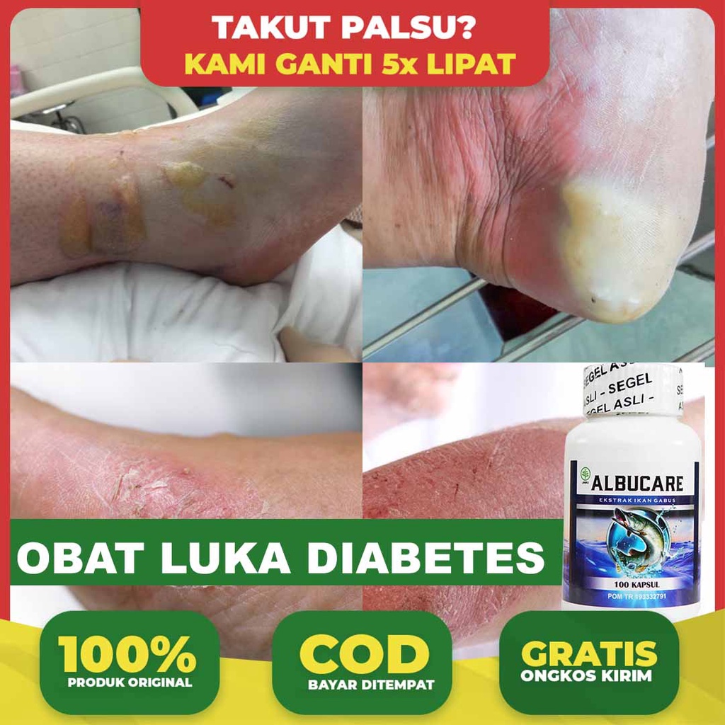 Jual Obat Luka Diabetes Melitus Basah Menghilangkan Bekas Sesar