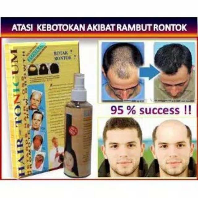 Jual TERBUKTI PALING CEPAT Obat Penumbuh Rambut Rontok Botak Kering ...