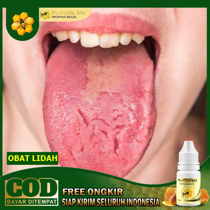 Jual Obat Herbal Lidah Perih Lidah Pecah Pecah Obat Sariawan Lidah Propolis Sm Shopee