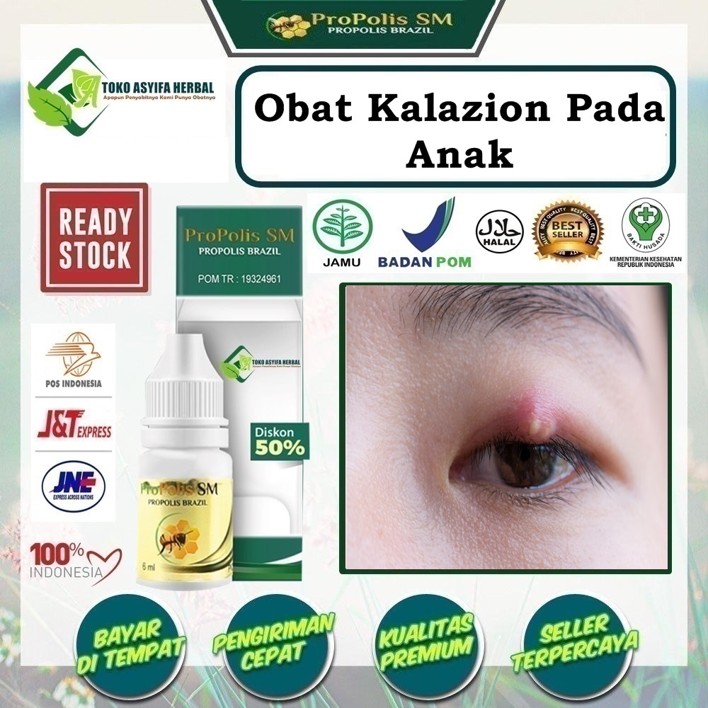 Jual Obat Kalazion Pada Anak, Obat Mata Bintitan, Obat Bintitan Di ...