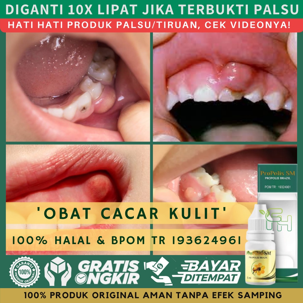 Jual Obat Gusi Bengkak Radang Gusi Berdarah Gusi Bernanah Abses Gusi ...