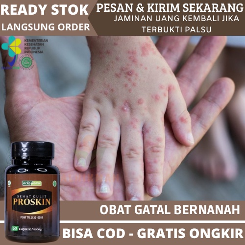 Jual Obat Scabies, Obat Gatal Scabies, Obat Scabies Manusia, Obat Budug ...