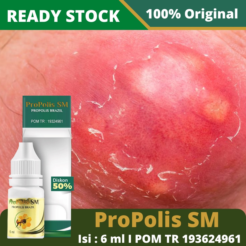Jual Obat Bisul, Bisul Bernanah, Pereda Nyeri Bisul, Salep Bisul di ...