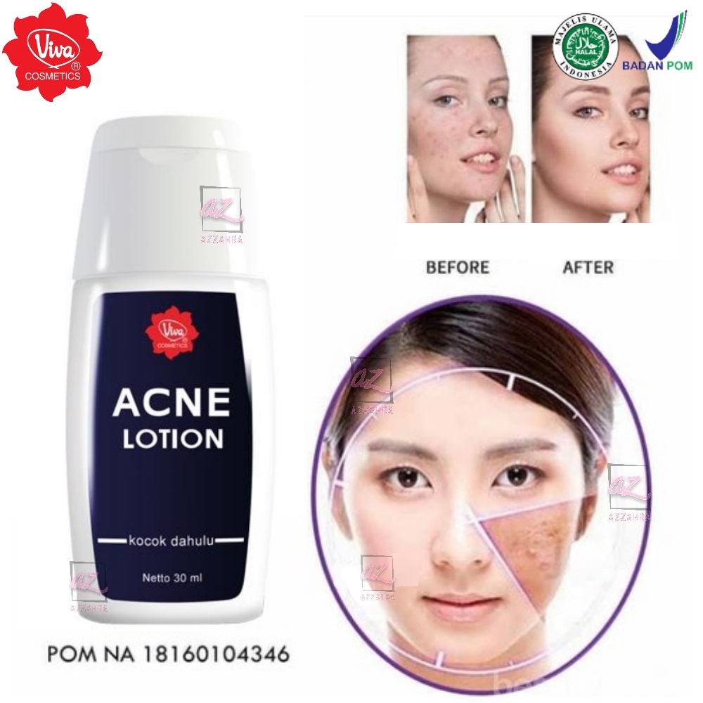 Jual Viva Acne Lotion 30ml Lotion Triple Action Shopee Indonesia