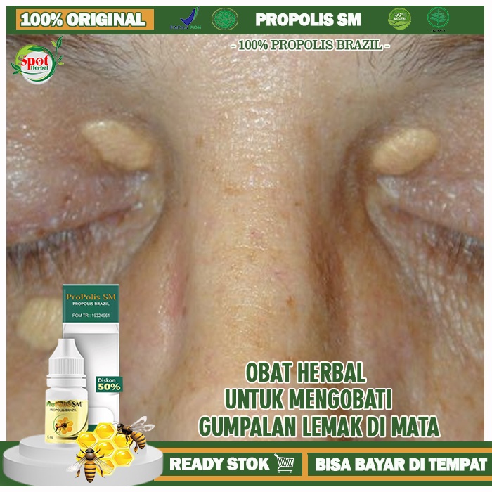 Jual Obat Xanthelasma Obat Gumpalan Lemak Di Kelopak Mata Obat