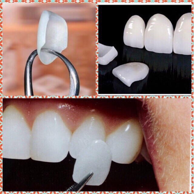 Jual Veneer Gigi Isi 50 Venner Teeth Bunny Tooth Pelapis Cetakan Vener
