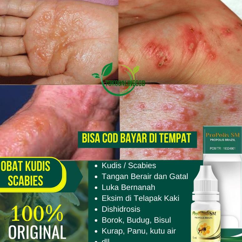 Jual Obat Kudis Scabies Tangan Berair Dan Gatal Luka Bernanah Eksim