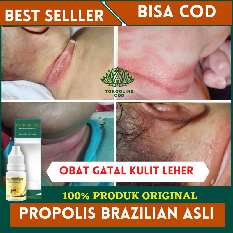Jual Obat Gatal Kulit Leher, Biang Keringat Bayi, Ruam Kulit, Lecet