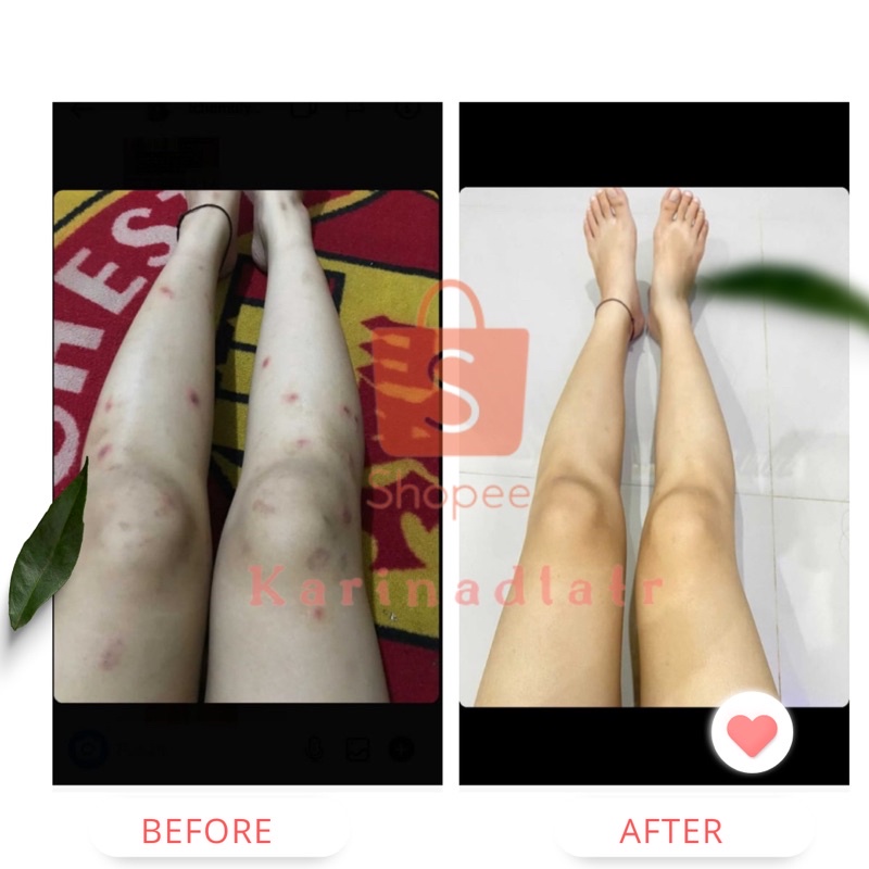Jual PENGHILANG BEKAS LUKA DAN KELOID SCARS CREAM REMOVEL | Shopee ...