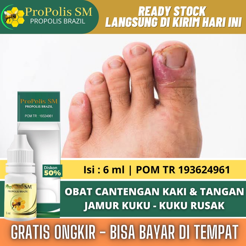 Jual Obat Cantengan Jempol Kaki Di Kuku Dan Di Tangan Cantengan Kuku