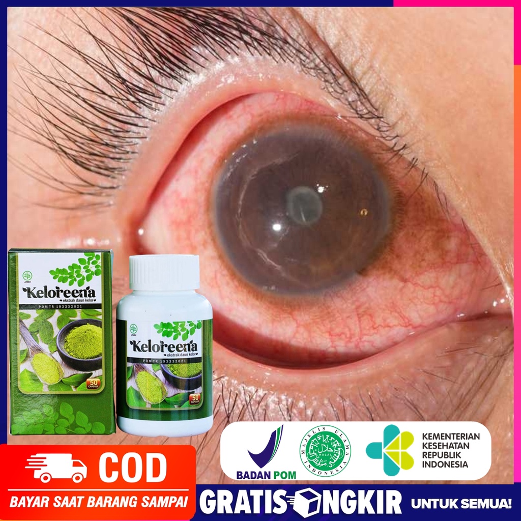 Jual Obat Infeksi Mata Penyakit Konjungtivitis, Gatal, Berair, Radang ...