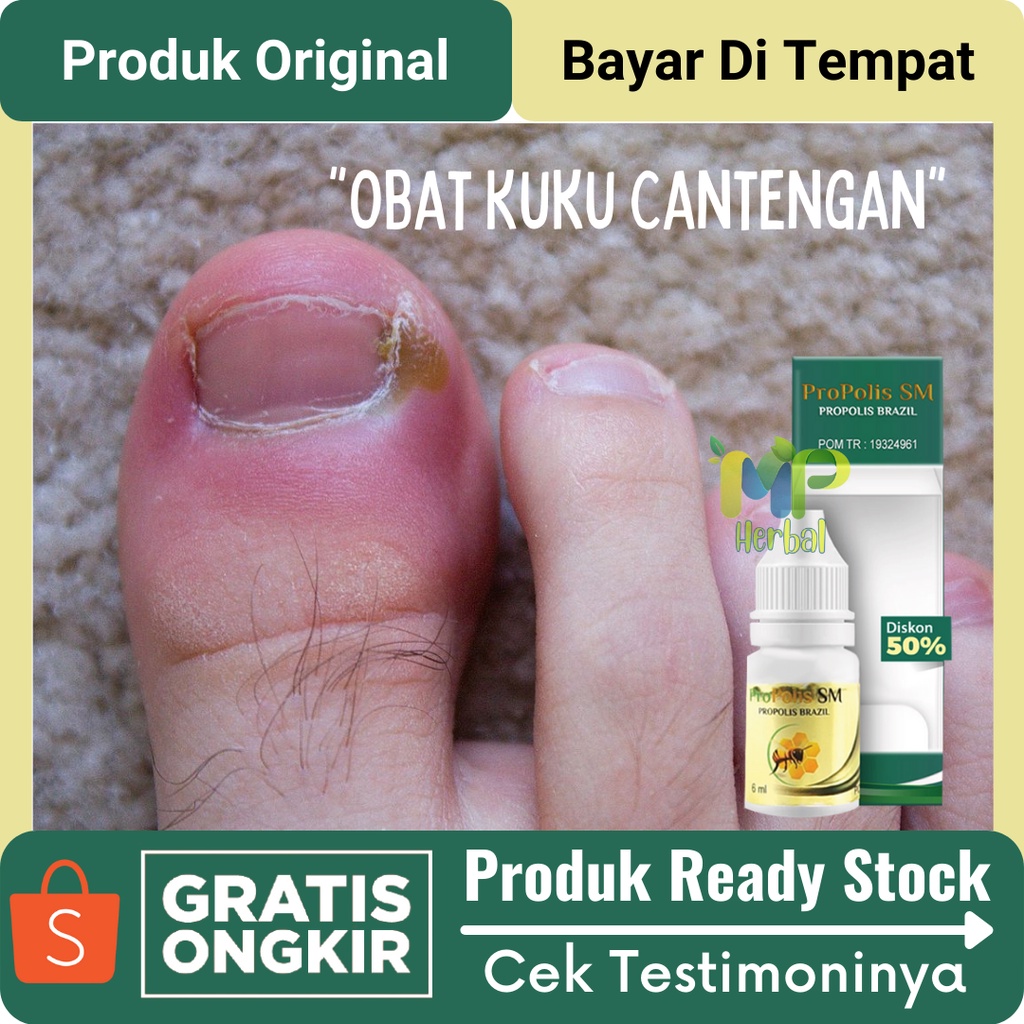 Jual Obat Cantengan Jempol Kaki Bengkak Dan Bernanah - Obat Herbal Kuku ...