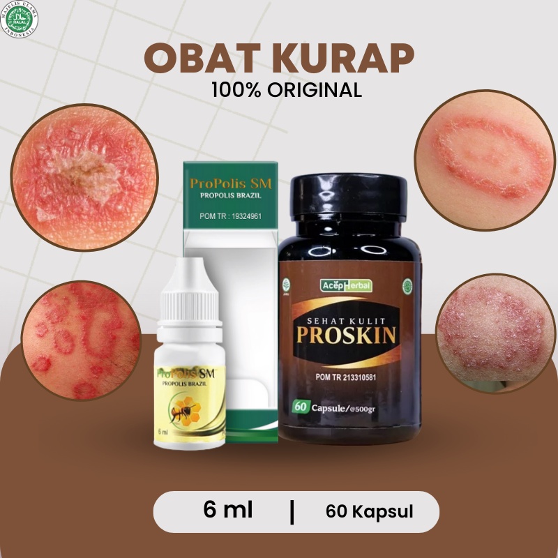 Jual Proskin - Obat Kurap, Obat Kudis, Salep kurap kadas kudis gatal ...