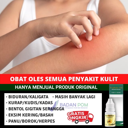 Jual Obat Oles Segala Penyakit Kulit Gatal Gatel Biduran Kaligata