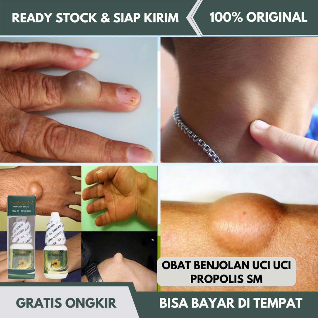 Jual Obat Benjolan Uci Uci, Obat Benjolan Lipom, Benjolan Lemak, Obat ...