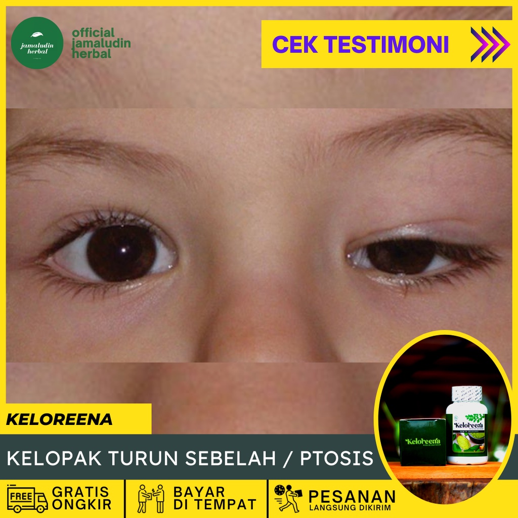 Jual Obat Kelopak Mata Kendur Obat Mata Ptosis Obat Alami Mata Ptosis Obat Menaikan