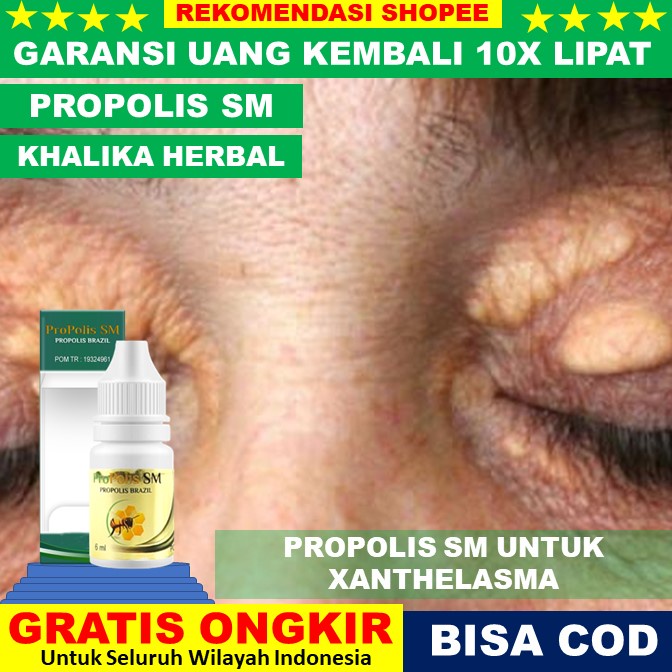 Jual Obat Penghilang Xanthelasma / Santelasma / Plak Kuning Di Kelopak ...