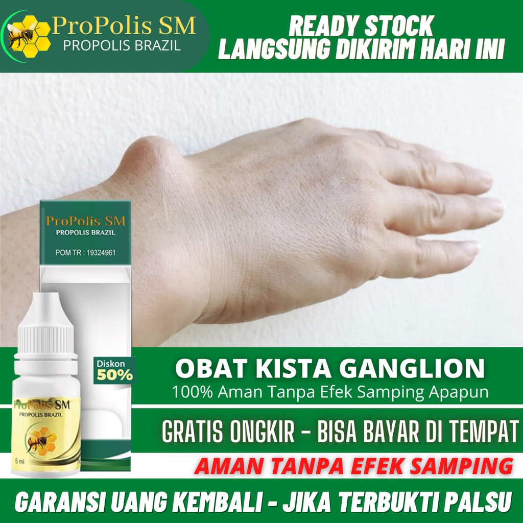 Jual Obat Oles Penghancur Benjolan Ganglion, Pengecil Kista Ganglion ...