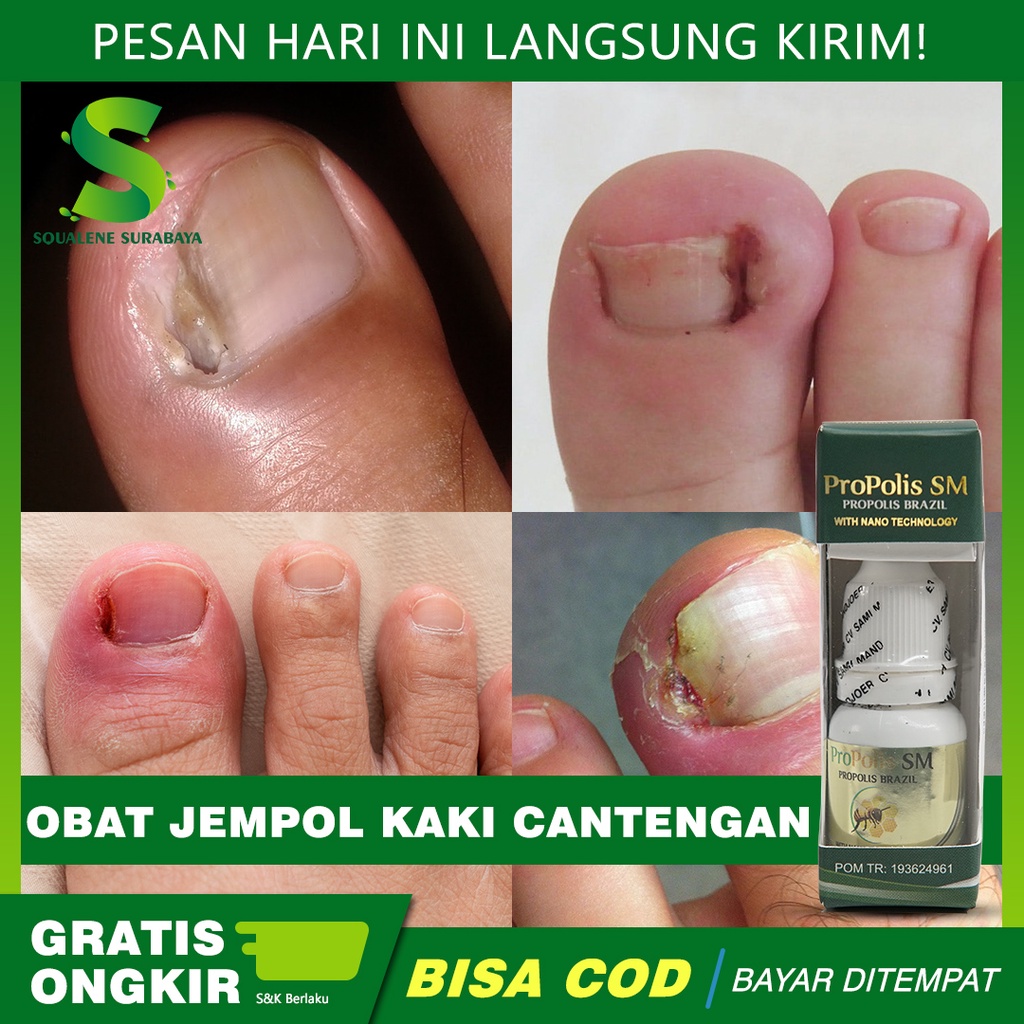 Jual Obat Jempol Kaki Cantengan Kuku Tangan Cantengan Kuku Tangan