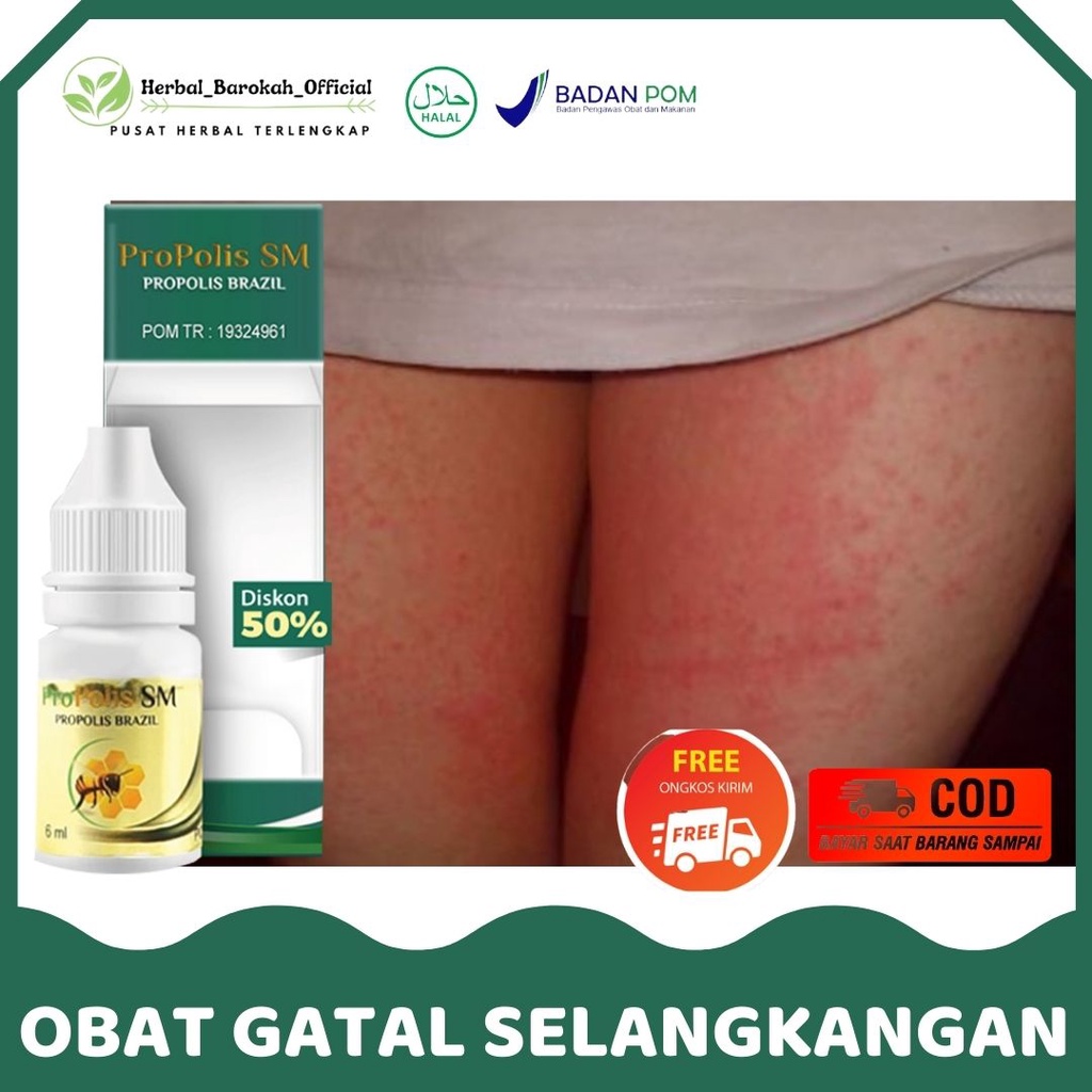 Jual Obat Gatal Selangkangan Bentol Gatal Bekas Pembalut Jamur Di Selangkangan Ruam 4195