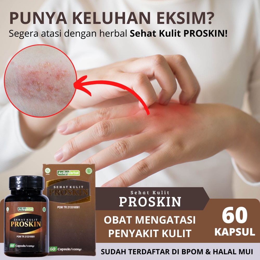 Jual Obat Eksim Ruam Gatal Kulit Luka Basah Kering Bersisik Dermatitis ...