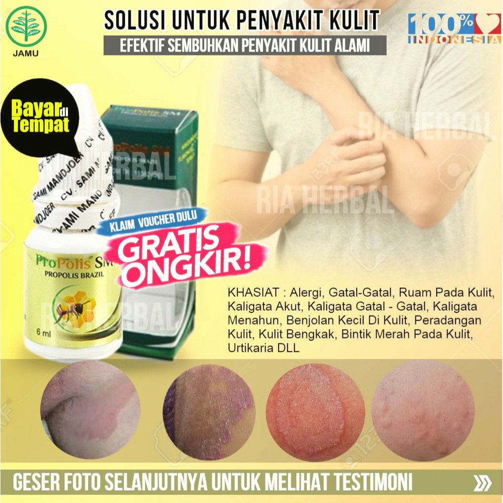 Jual [cod] Obat Untuk Mengeringkan Luka Eksim Basah Dan Kering Eksim