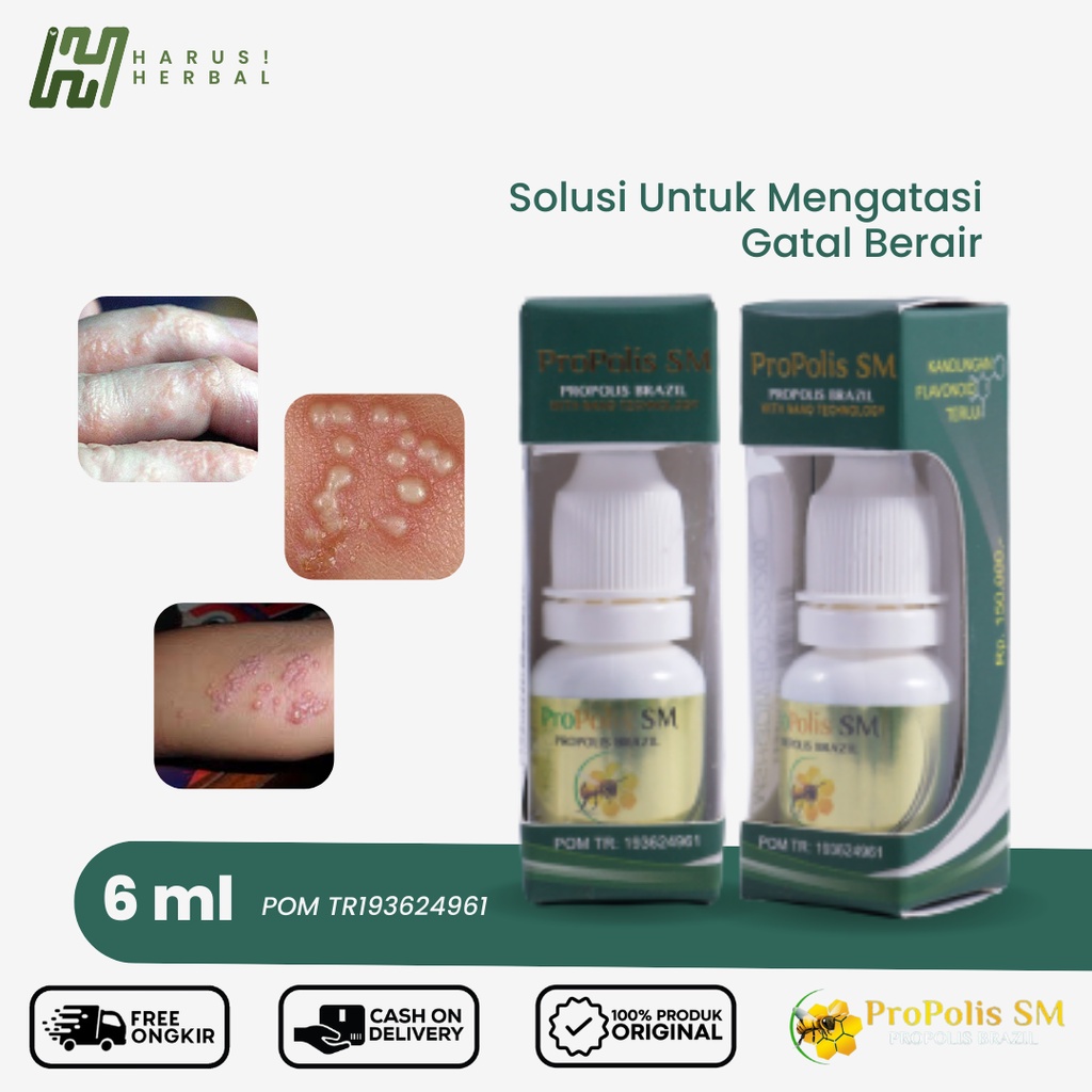 Jual Propolis Sm Obat Kulit Gatal Berair Di Jari Obat Bintik Berair Di Tangan Beruntusan 5011