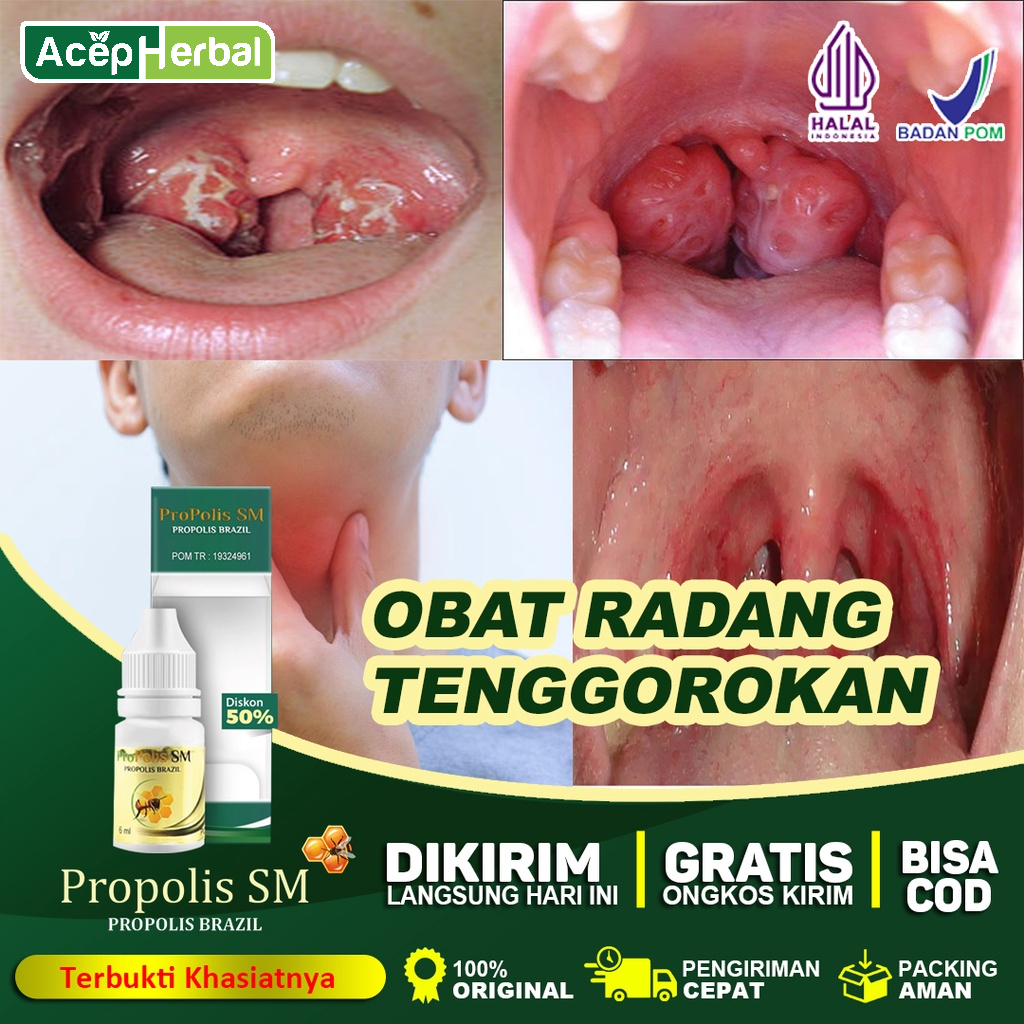 Jual Obat Radang Tenggorokan Amandel Sakit Tenggorokan Panas Dalam