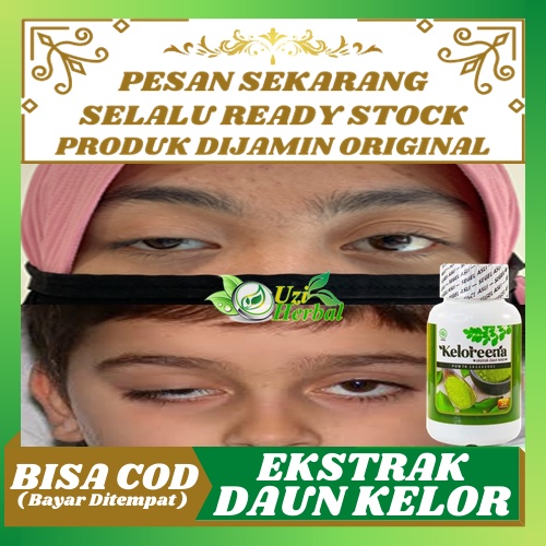 Jual Obat Mata Ptosis Kelopak Mata Turun Mata Sipit Sebelah Mata