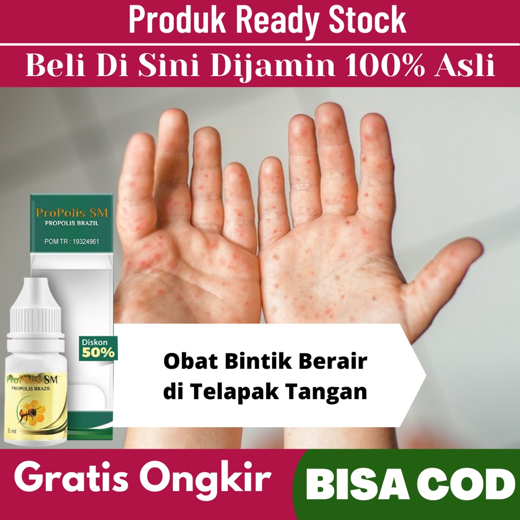 Jual Obat Bintik Berair Di Telapak Tangan Obat Bintik Berair Gatal Di