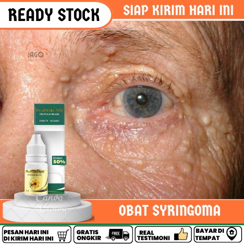 Jual Obat Syringoma Penghilang Syringoma Obat Gumpalan Lemak Di